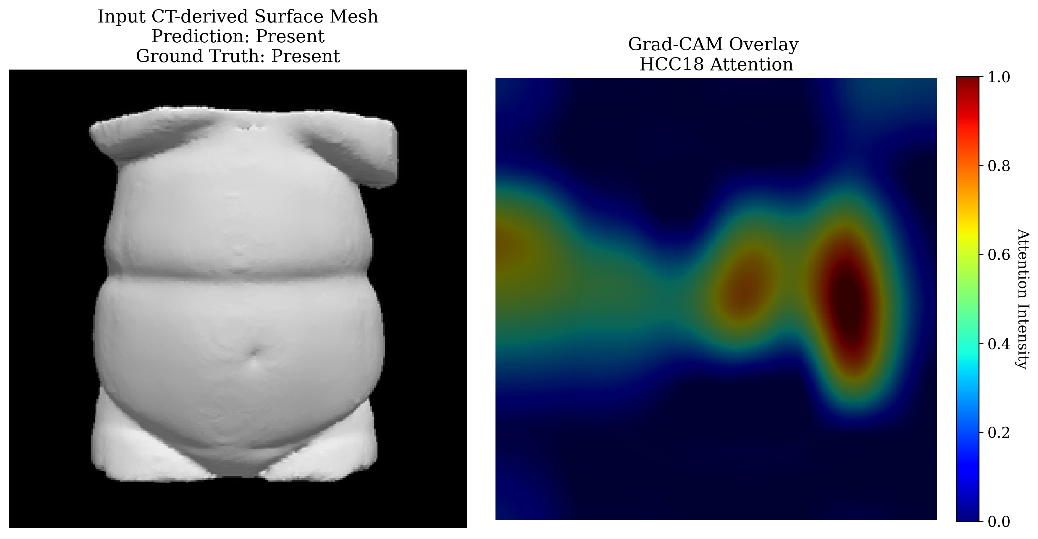 Grad-CAM visualization 2 for HCC-18 prediction