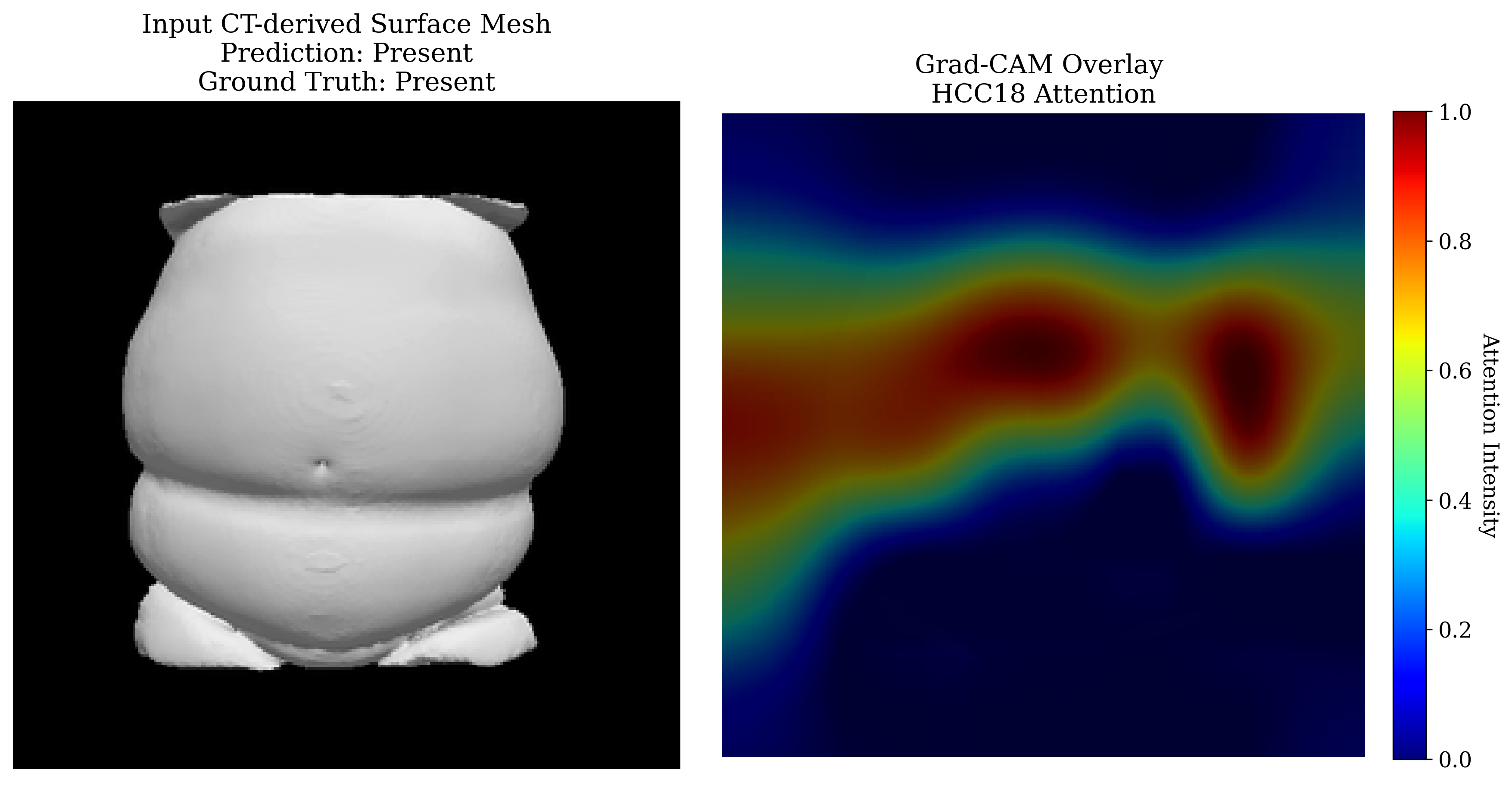 Grad-CAM visualization 1 for HCC-18 prediction